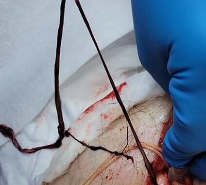 covid vaccine clots in dead persons